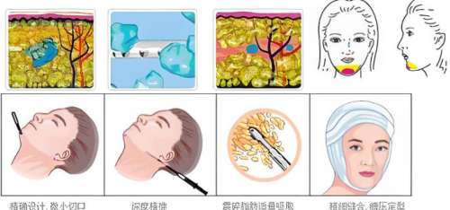 吸脂