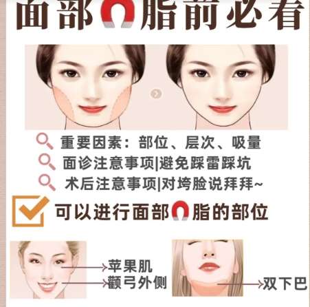 面部吸脂