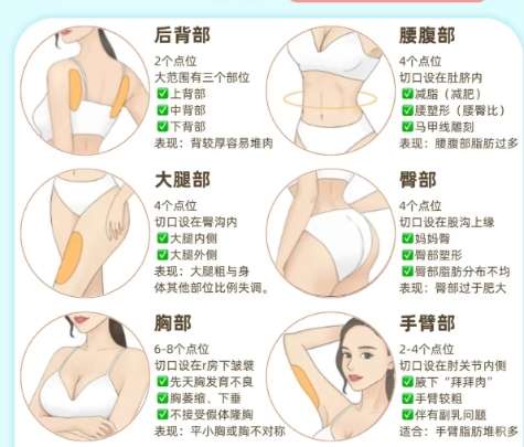 吸脂 吸脂