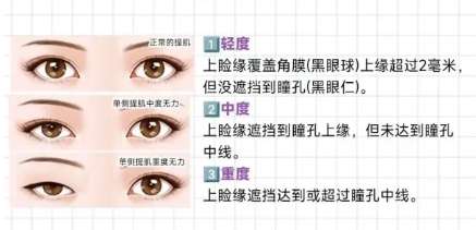 双眼皮