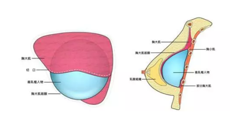 10隆胸.png