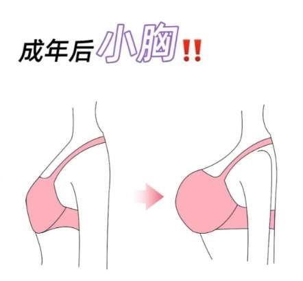 隆胸