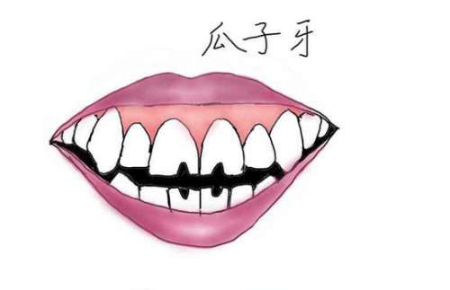 瓜子牙4.jpg