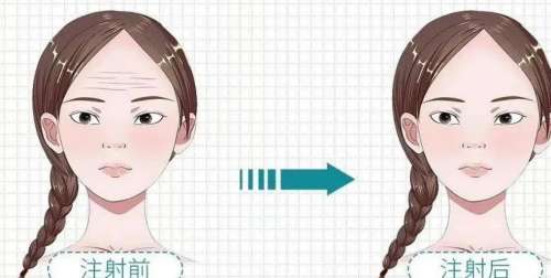 童颜针和少女针.jpg