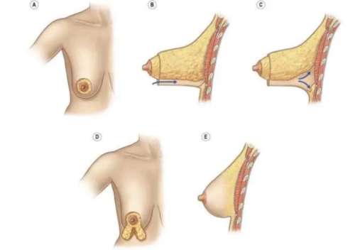 乳房悬吊术.jpg