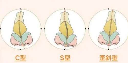 歪鼻矫正动漫02.jpg