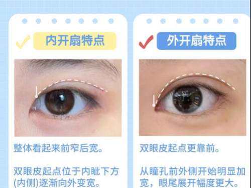 双眼皮7.jpg 双眼皮7.jpg