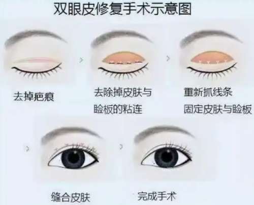 双眼皮