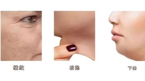 热玛吉 热玛吉
