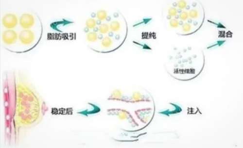自体脂肪填充隆