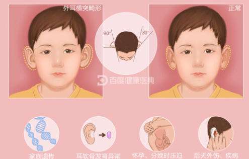 招风耳3.jpg 招风耳3.jpg