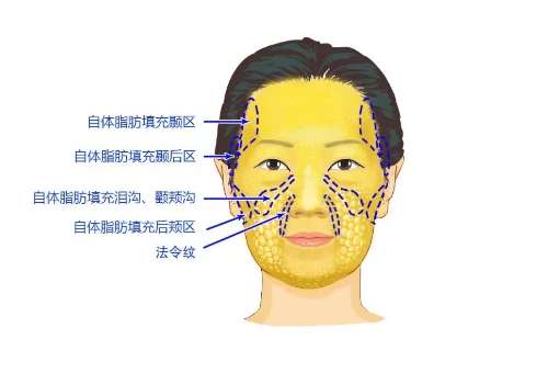 脂肪整形.jpg