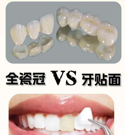 全瓷牙 全瓷牙