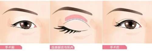 双眼皮 双眼皮