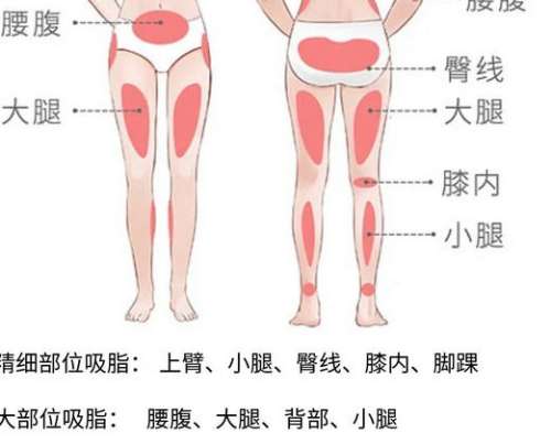大腿吸脂dmm2.jpg
