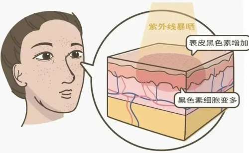 祛斑 祛斑