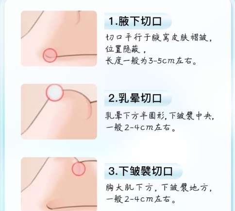 隆胸