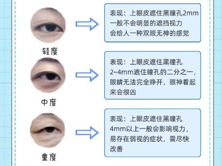 双眼皮