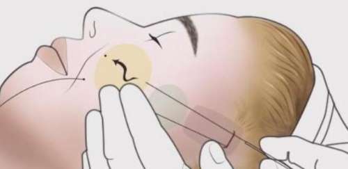 除皱 除皱