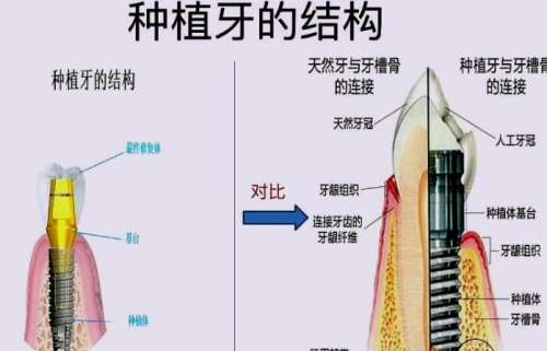 牙齿种植