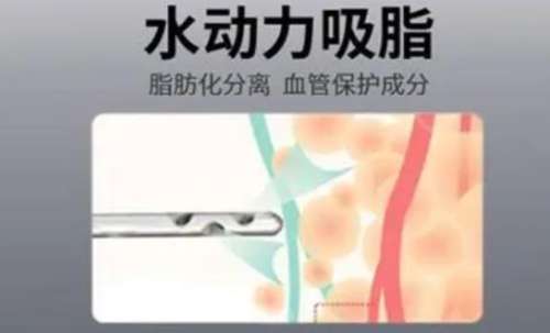 水动力吸脂.jpg