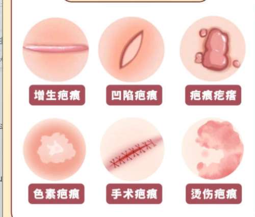 祛疤.jpg 祛疤.jpg
