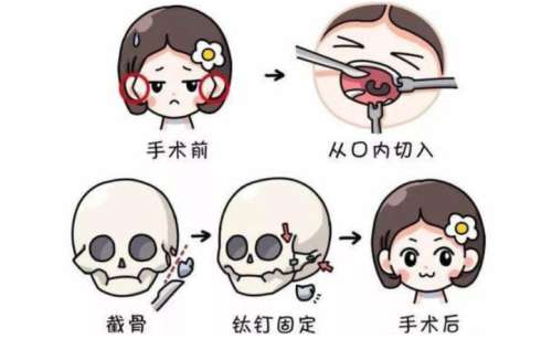 磨骨