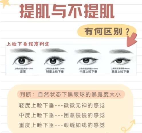 双眼皮 双眼皮