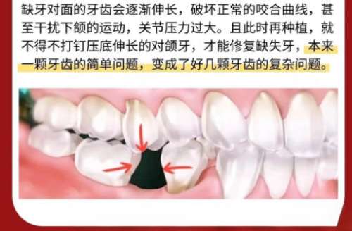 牙齿种植2.jpg