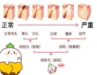 祛痘 祛痘