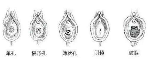 处女膜修复 处女膜修复