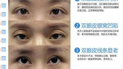 双眼皮修复.jpg