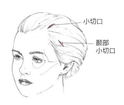 拉皮 拉皮