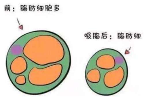 吸脂.jpg