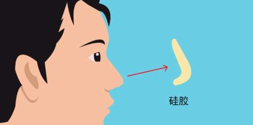 隆鼻