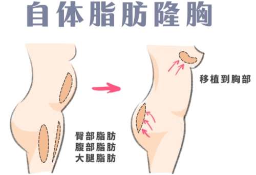 自体脂肪隆胸 自体脂肪隆胸