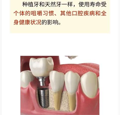 牙齿种植