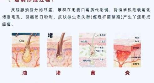 祛痘3.jpg 祛痘3.jpg