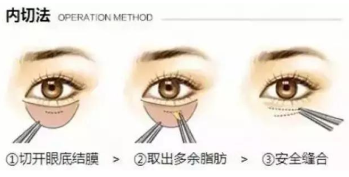 21眼袋.png