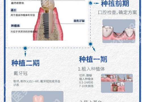 中山市种牙中山市哪里种牙技术好？精选优质医院推荐及项目详解！