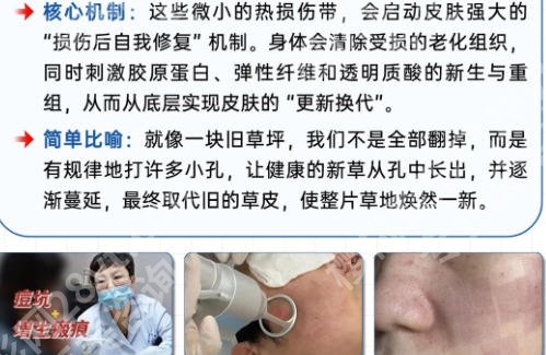 柳州人民医院点阵激光收费怎么样?热门项目激光案例展示