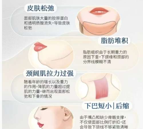 下颌缘提升