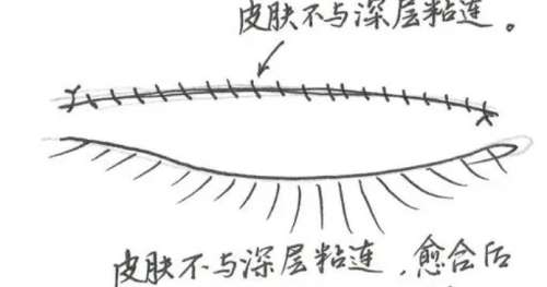 双眼皮