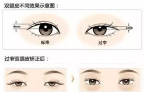 双眼皮2.png