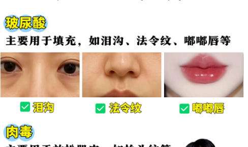 玻尿酸 玻尿酸
