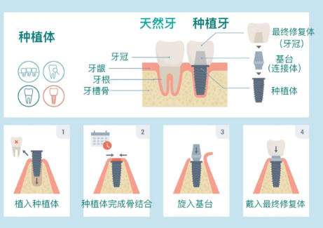 牙齿种植