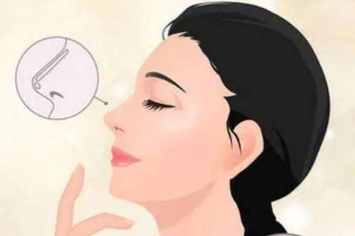 隆鼻 隆鼻