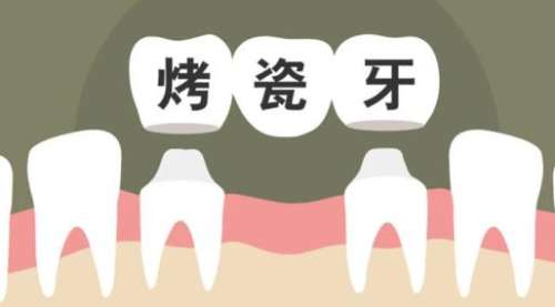 烤瓷牙01.jpg