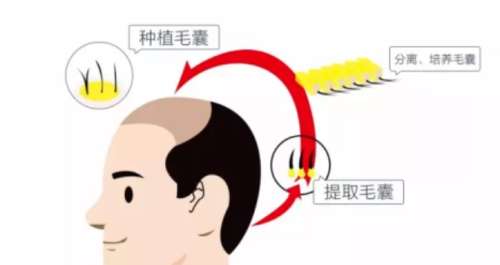 植发 植发