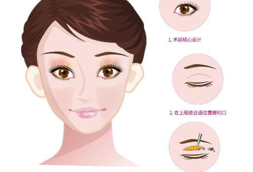 双眼皮手术原理动漫8.jpg